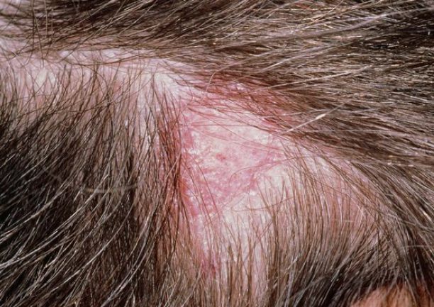 M2700155-Tinea_capitis_ringworm_of_the_scalp.max-600×600 M2700155-Tinea_capitis_ringworm_of_the_scalp.max-600x600