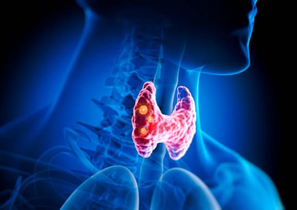 Thyroid gland with nodules inside human body – 3D illustration Thyroid gland with nodules inside human body - 3D illustration