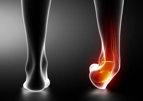 Sprained ankle black x-ray in 3D Sprained ankle black x-ray in 3D