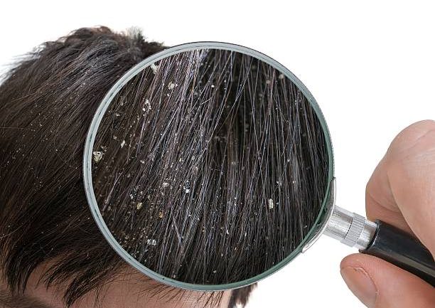 Examiming white dandruff flakes in hair with magnifying glass. Examiming white dandruff flakes in hair with magnifying glass.