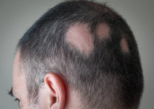 Alopecia areata Alopecia areata